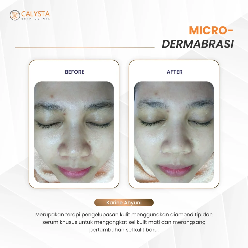 Microdermabrasi Calysta Skin Clinic