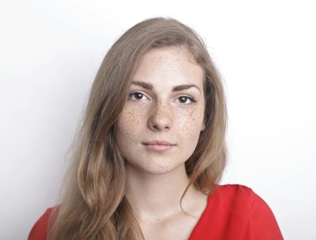 Perbedaan Freckles Melasma dan Flek Hitam