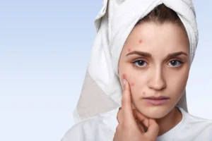 Kulit Berjerawat? Simak 9 Solusi Treatment Untuk Kulit Berjerawat!