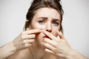 Skincare Penghilang Bekas Jerawat? Berikut Rekomendasinya