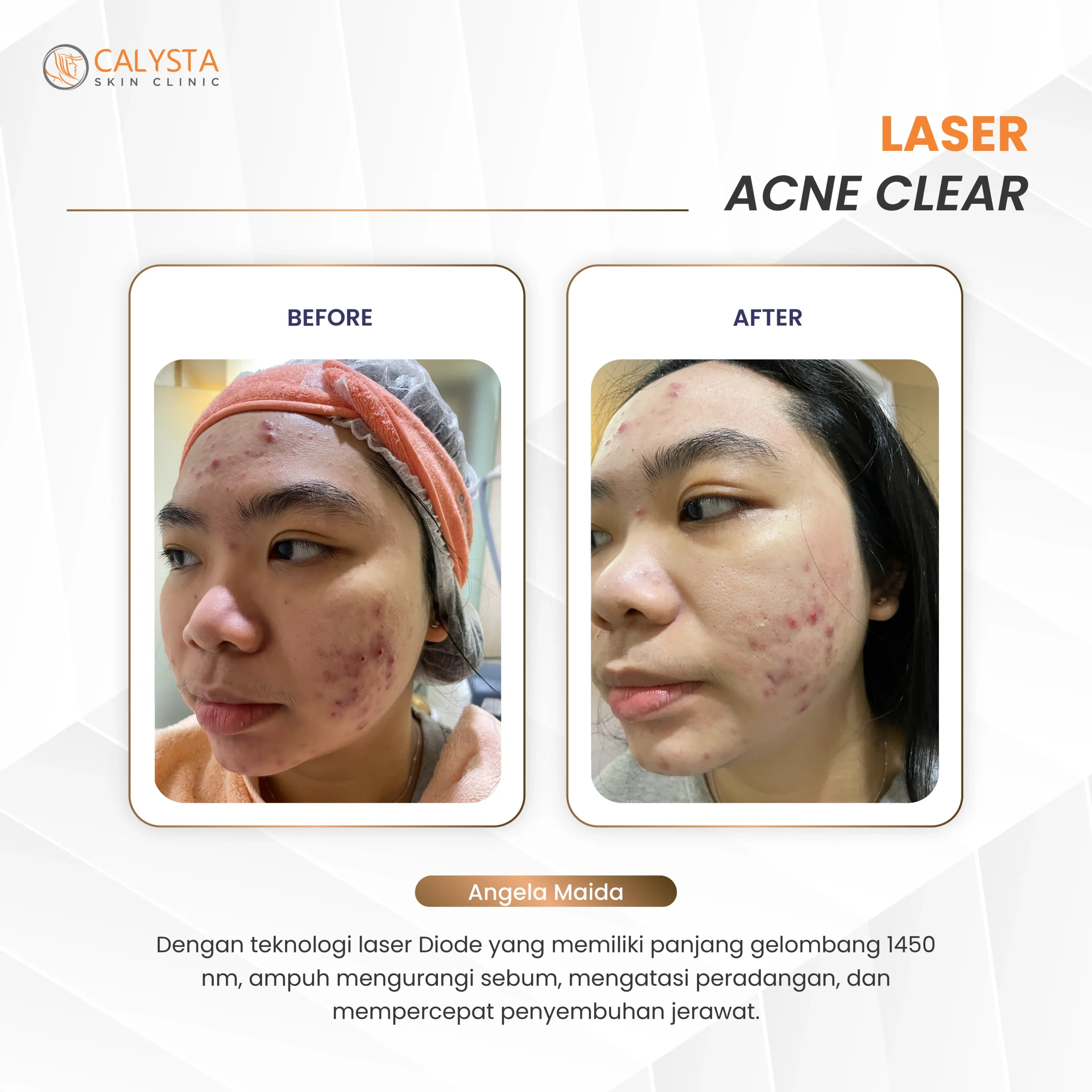before-after laser acne clear 1