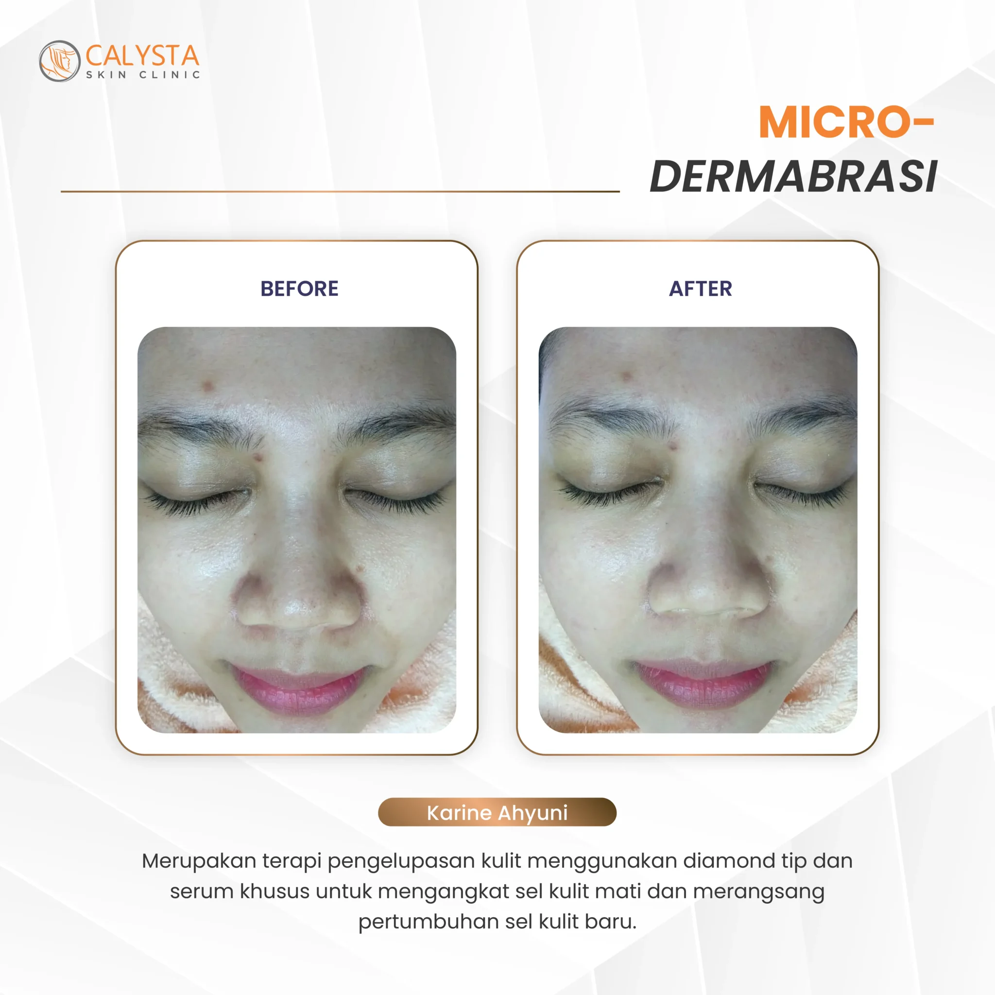 before-after microdermabrasi 1