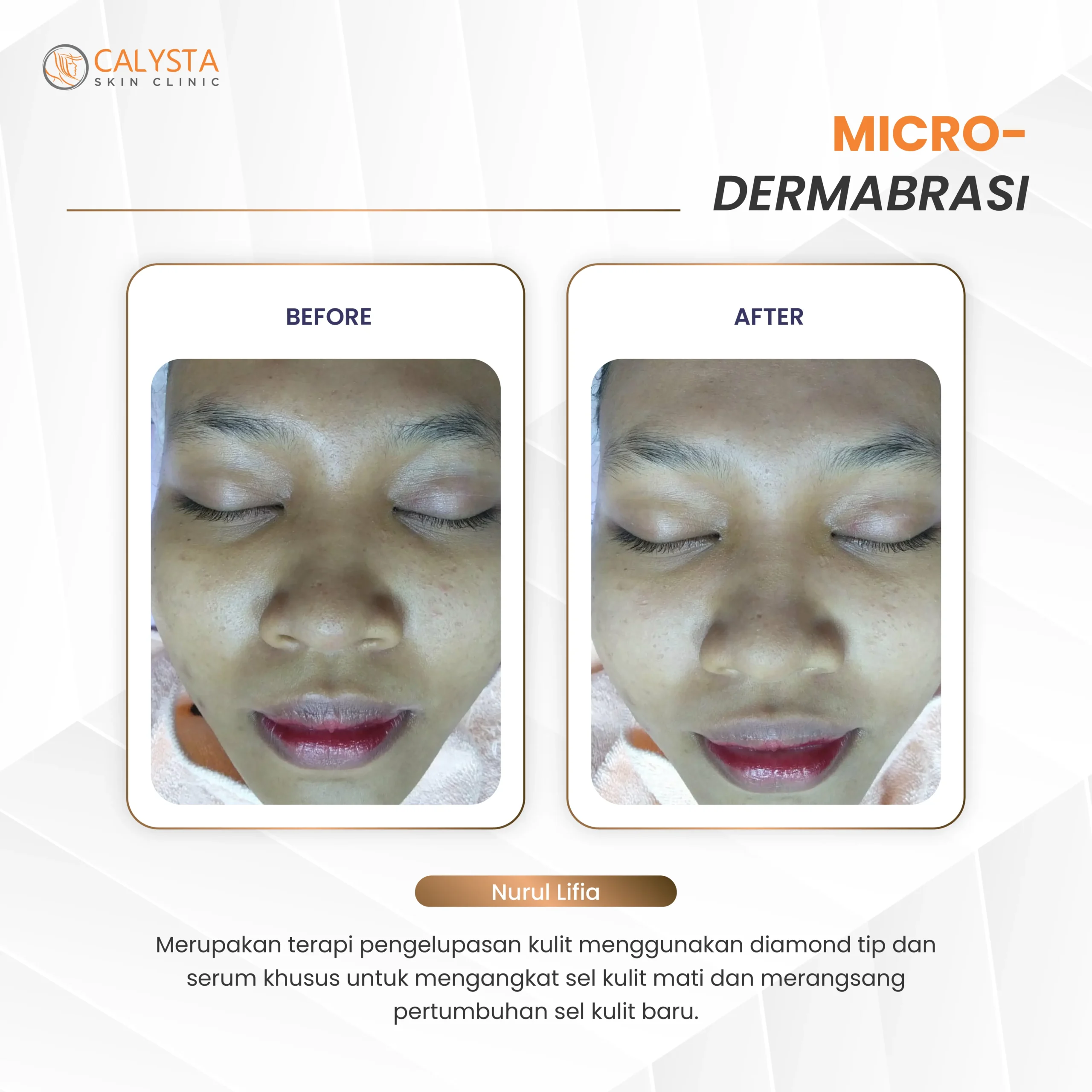 before-after microdermabrasi 2