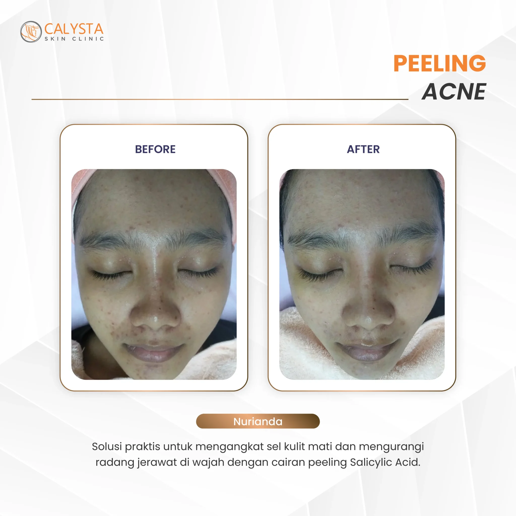 before-after peeling acne 1