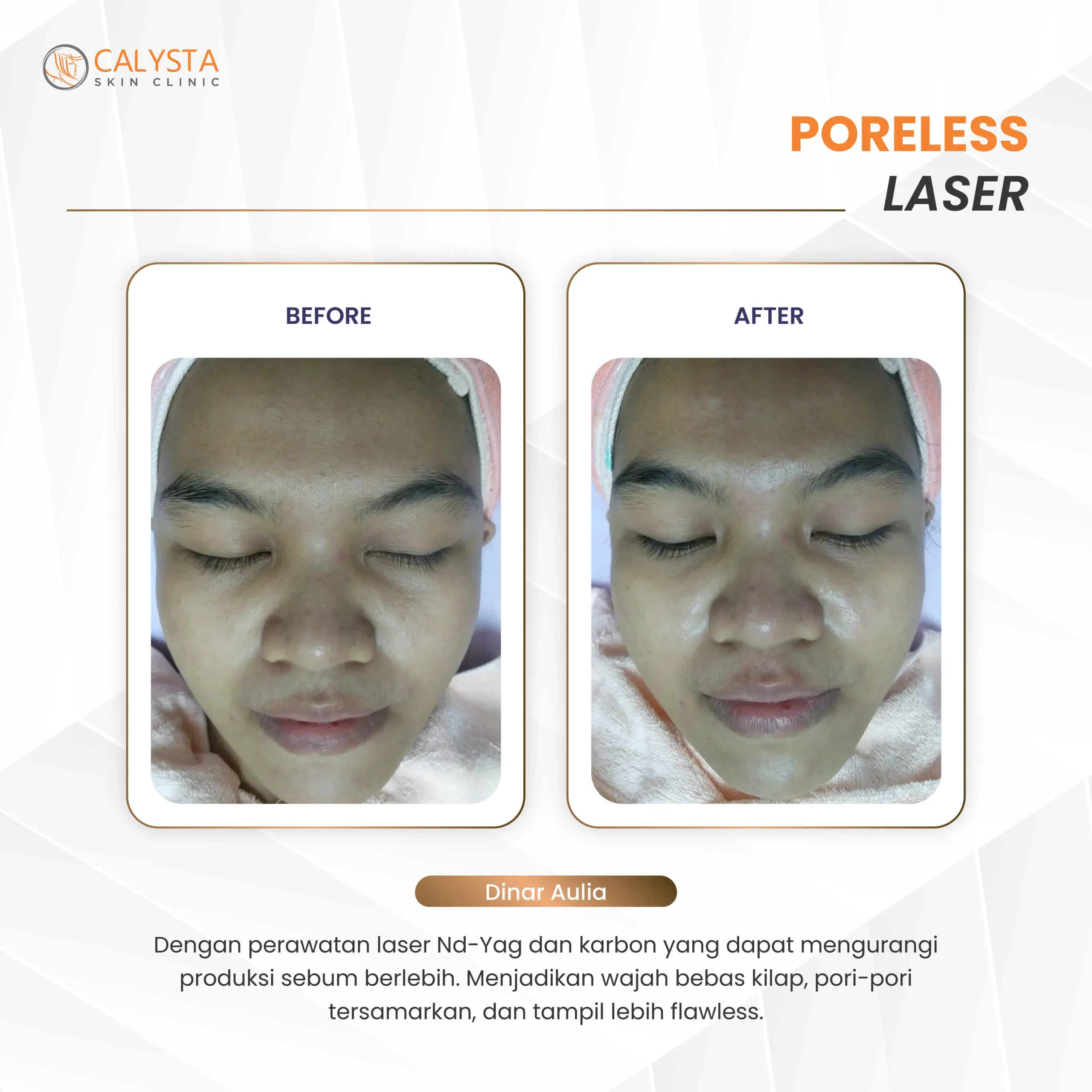 before-after poreless laser 1