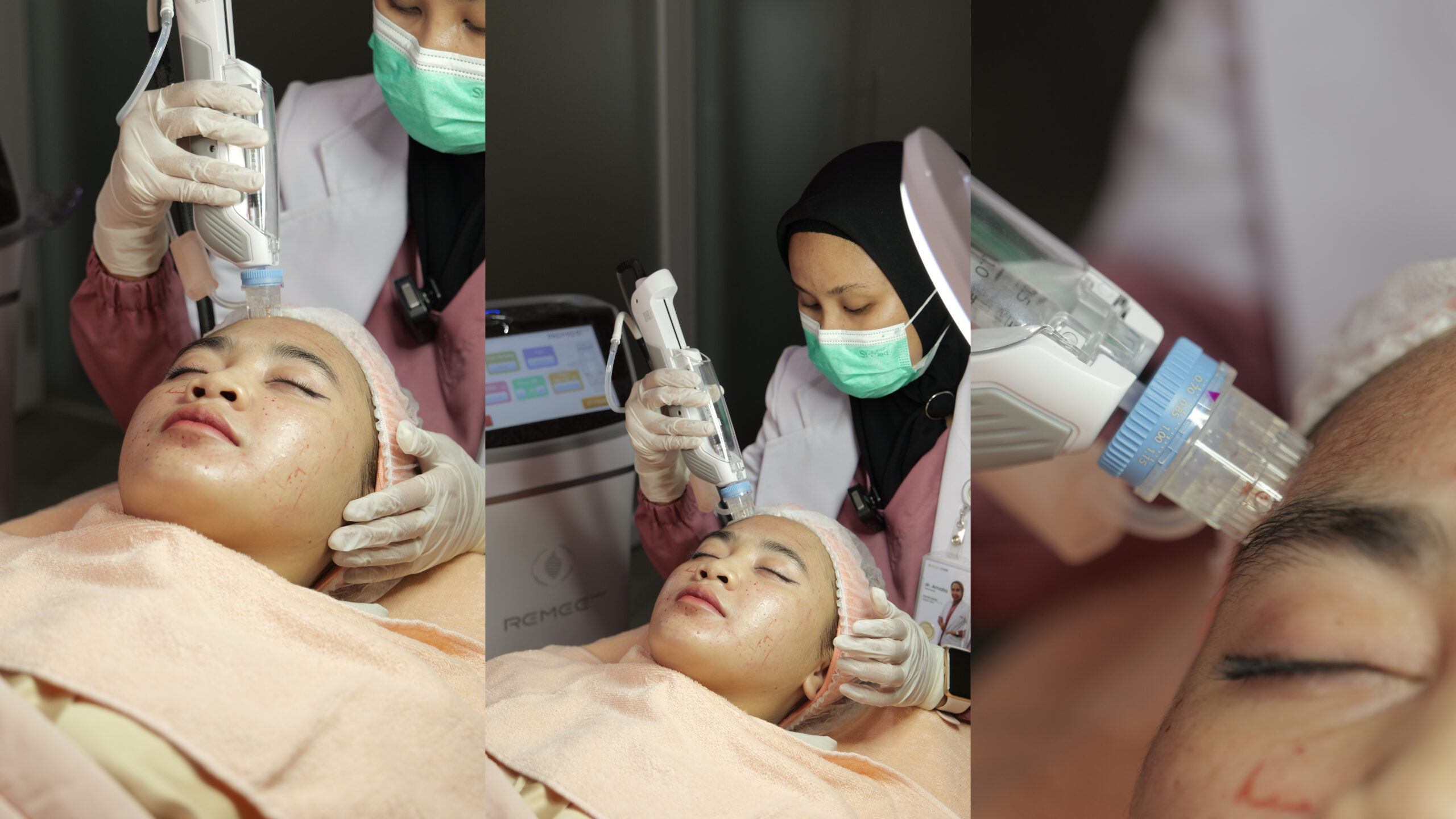 Atasi Bekas Jerawat & Kerutan dengan Rejuran Calysta