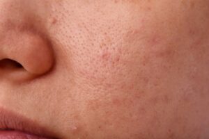7 Cara Mengecilkan Pori-pori untuk Kulit Sehat Alami