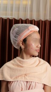 Pelajari Penyebab Bruntusan di Wajah dan Cara Mengatasinya