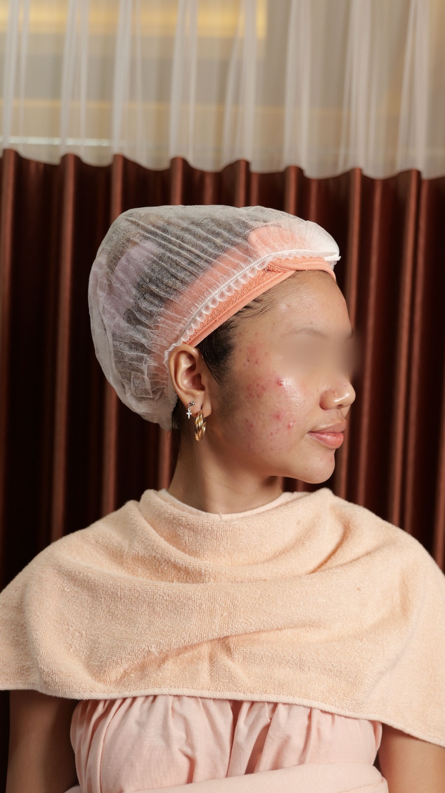 Penggunaan produk skincare yang baru menjadi salah satu penyebab munculnya bruntusan di wajah. Terlebih dengan banyaknya produk kecantikan yang ada membuat kita sering kali mencoba-coba skincare. Padahal, hal tersebut sangat tidak dianjurkan oleh para dermatologis.