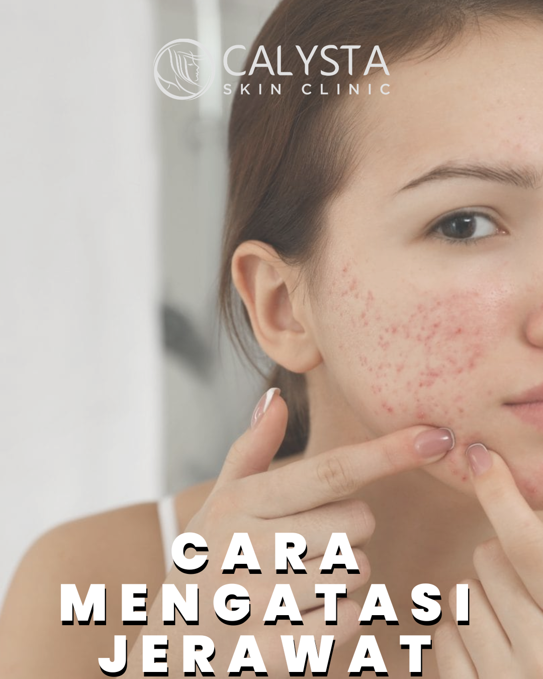 Dokter akan merekomendasikan produk yang tepat untuk meredakan jerawat. Dalam beberapa kasus, tindakan seperti Facial / suntik diperlukan sebagai langkah cepat mematikan jerawat.